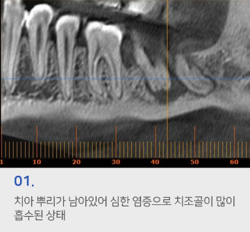 01 치아 뿌리가 남아있어 심한 염증으로 치조골이 많이 흡수된 상태