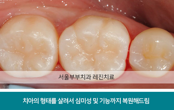 서울 부부치과 레진치료 치아의 형태를 살려서 심미성 및 기능까지 복원해드림