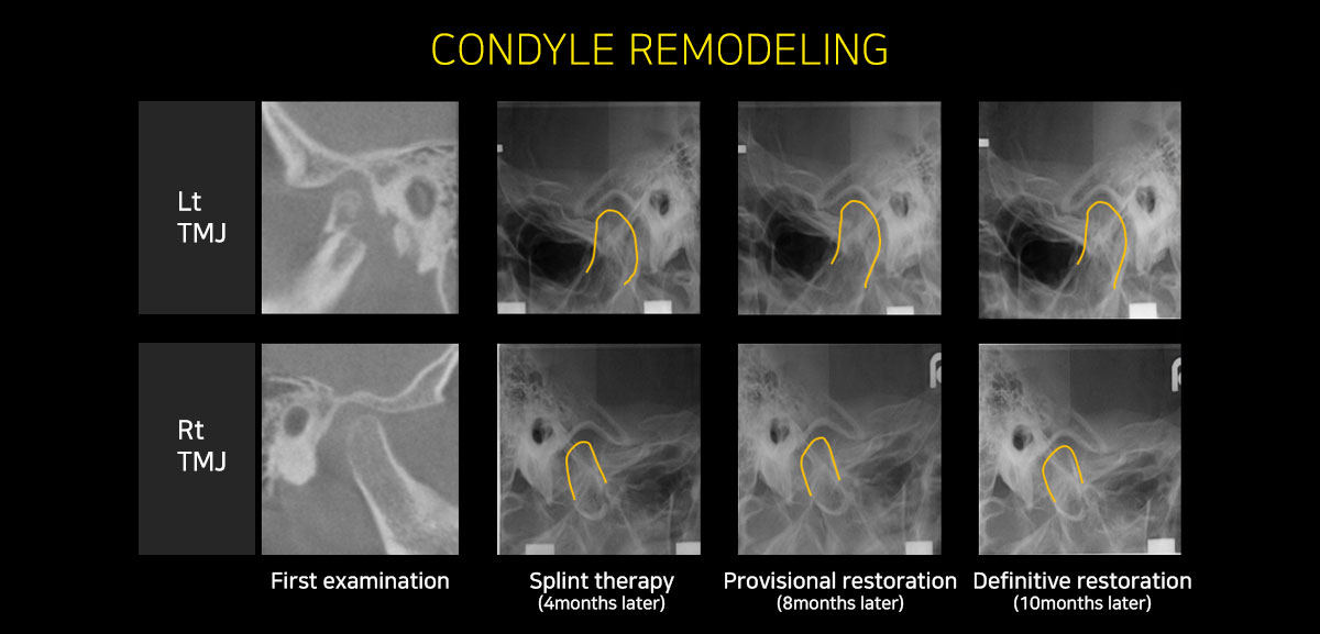 condyle remodeling